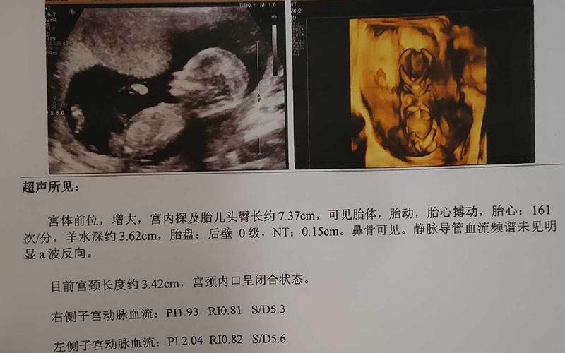 广州三代供卵试管双胞胎(广州三代供卵试管双胞胎:科技助力下的生育奇迹)